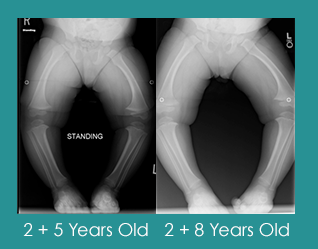 Blount's Disease What You Need to Know About the Disorder