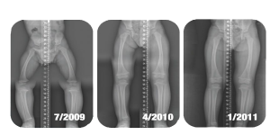 Pediatric X-Rays Showing Positive Patient Results